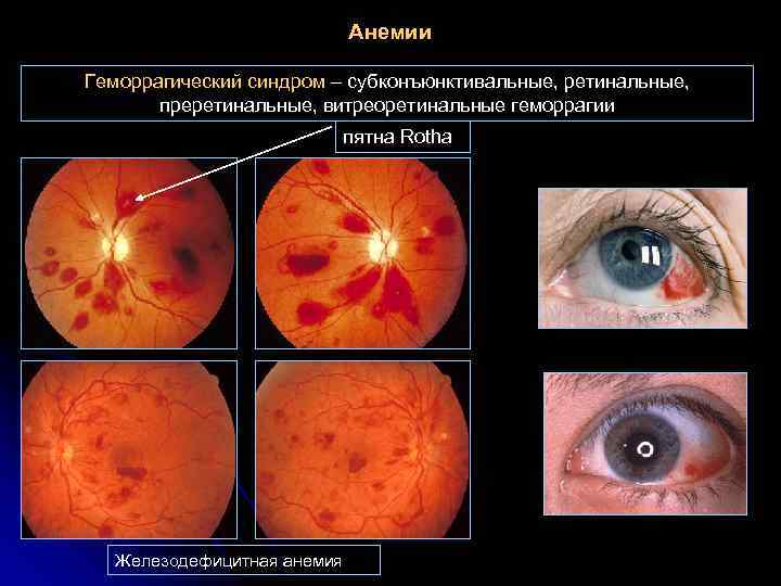 Анемии Геморрагический синдром – субконъюнктивальные, ретинальные, преретинальные, витреоретинальные геморрагии пятна Rotha Железодефицитная анемия 