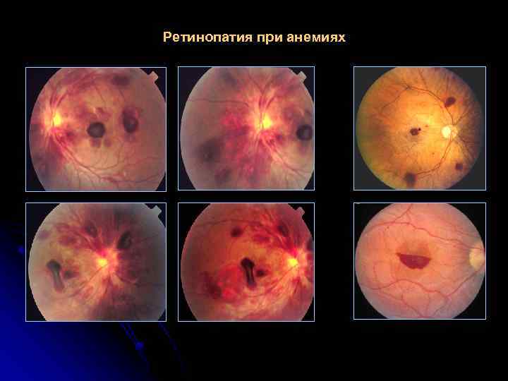 Ретинопатия при анемиях 