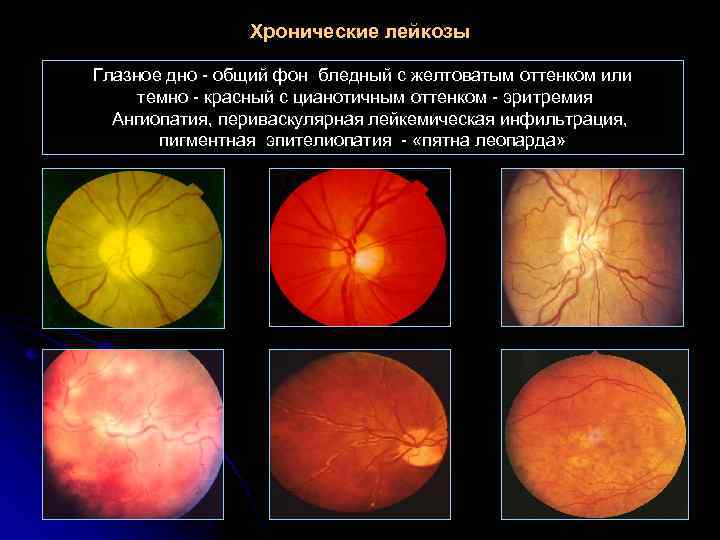 Хронические лейкозы Глазное дно - общий фон бледный с желтоватым оттенком или темно -