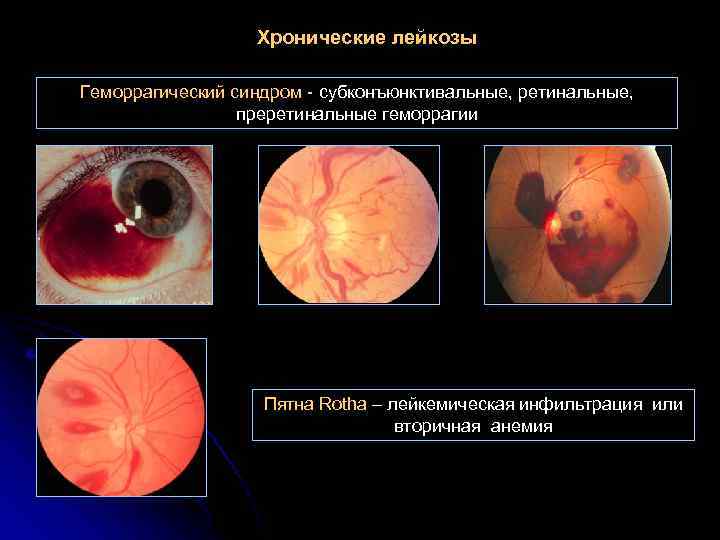 Хронические лейкозы Геморрагический синдром - субконъюнктивальные, ретинальные, преретинальные геморрагии Пятна Rotha – лейкемическая инфильтрация