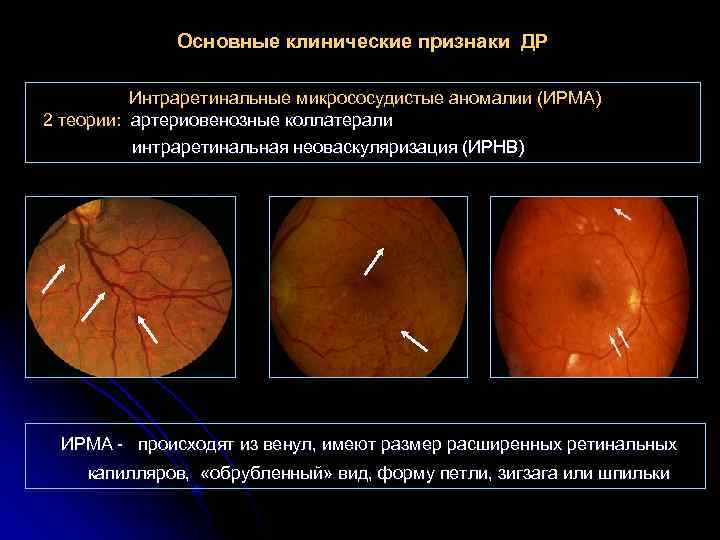 Основные клинические признаки ДР Интраретинальные микрососудистые аномалии (ИРМА) 2 теории: артериовенозные коллатерали интраретинальная неоваскуляризация