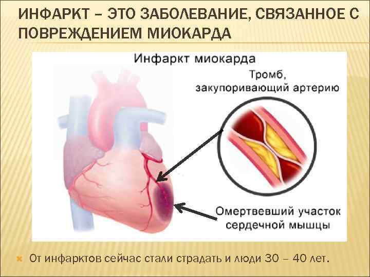 ИНФАРКТ – ЭТО ЗАБОЛЕВАНИЕ, СВЯЗАННОЕ С ПОВРЕЖДЕНИЕМ МИОКАРДА От инфарктов сейчас стали страдать и