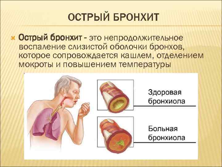 ОСТРЫЙ БРОНХИТ Острый бронхит - это непродолжительное воспаление слизистой оболочки бронхов, которое сопровождается кашлем,