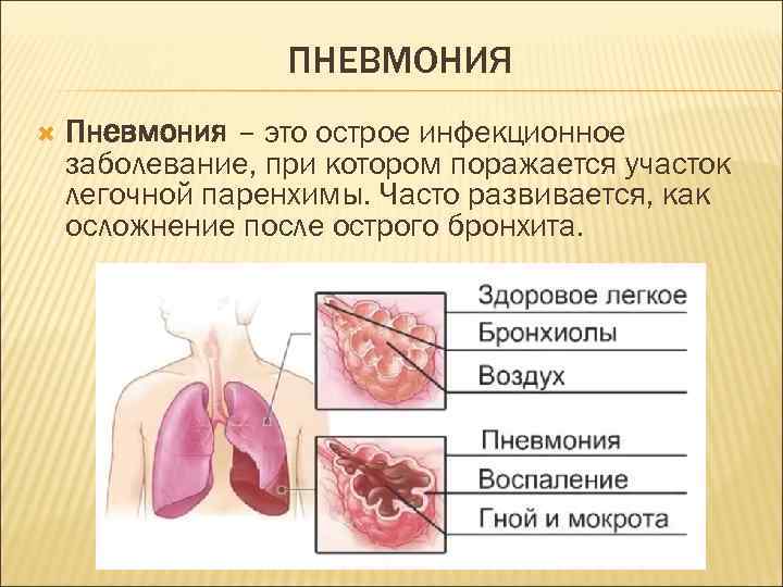 ПНЕВМОНИЯ Пневмония – это острое инфекционное заболевание, при котором поражается участок легочной паренхимы. Часто