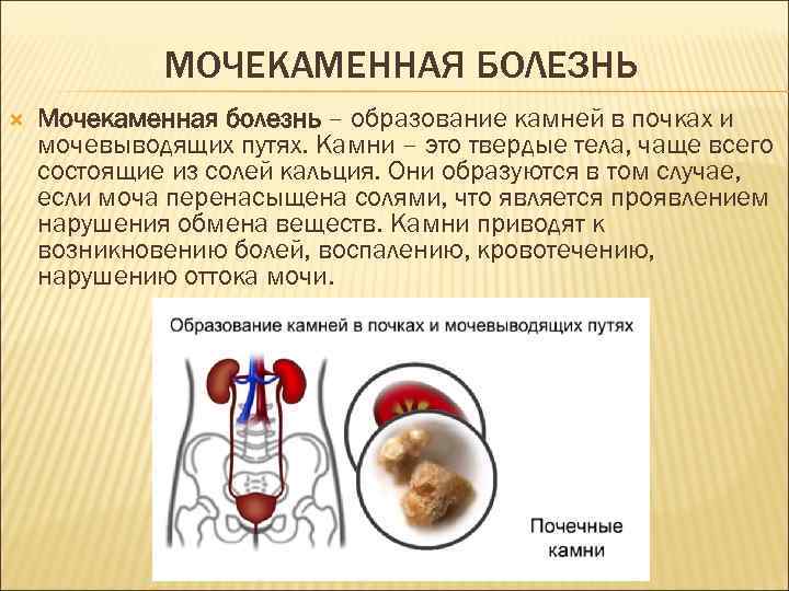 МОЧЕКАМЕННАЯ БОЛЕЗНЬ Мочекаменная болезнь – образование камней в почках и мочевыводящих путях. Камни –