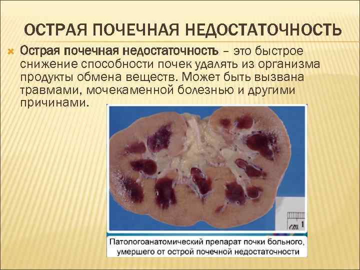 ОСТРАЯ ПОЧЕЧНАЯ НЕДОСТАТОЧНОСТЬ Острая почечная недостаточность – это быстрое снижение способности почек удалять из