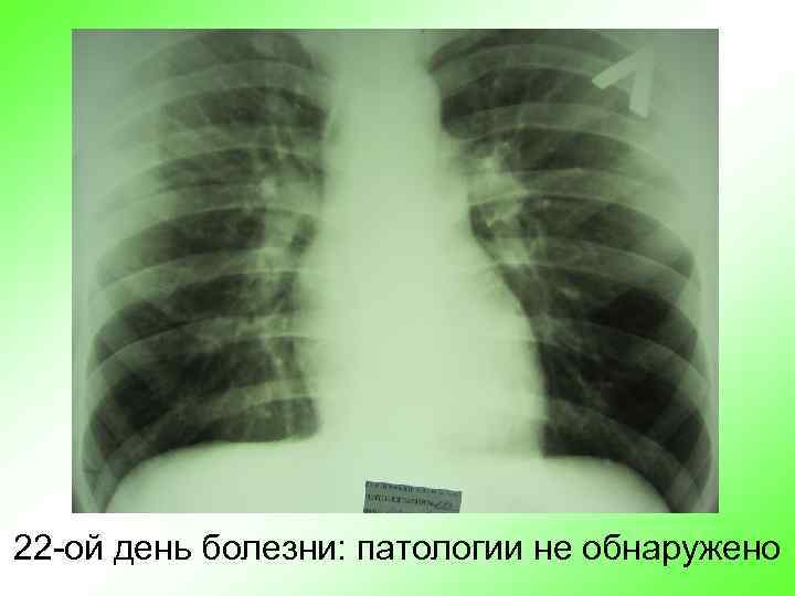 22 -ой день болезни: патологии не обнаружено 