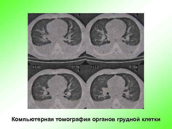 Компьютерная томография органов грудной клетки 