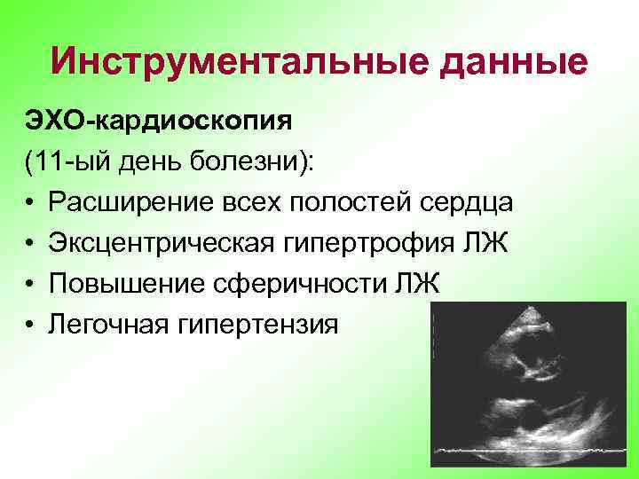 Инструментальные данные ЭХО-кардиоскопия (11 -ый день болезни): • Расширение всех полостей сердца • Эксцентрическая