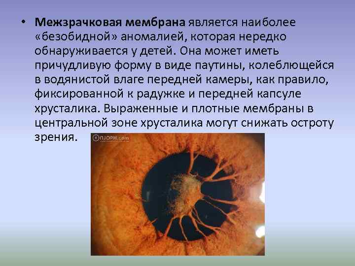  • Межзрачковая мембрана является наиболее «безобидной» аномалией, которая нередко обнаруживается у детей. Она