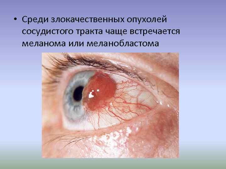  • Среди злокачественных опухолей сосудистого тракта чаще встречается меланома или меланобластома 