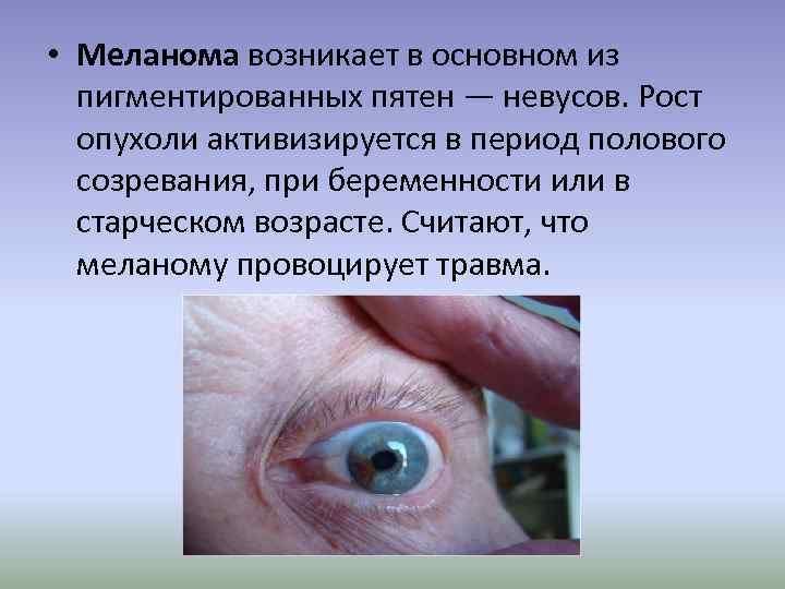  • Меланома возникает в основном из пигментированных пятен — невусов. Рост опухоли активизируется
