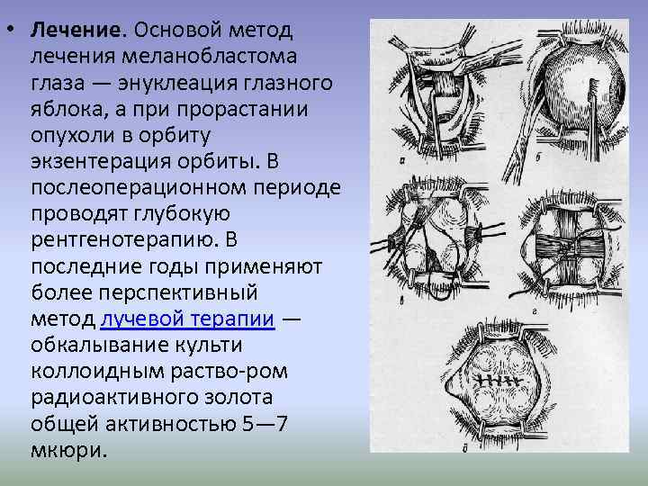  • Лечение. Основой метод лечения меланобластома глаза — энуклеация глазного яблока, а при