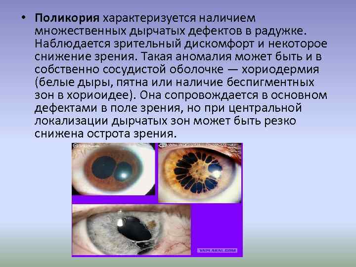  • Поликория характеризуется наличием множественных дырчатых дефектов в радужке. Наблюдается зрительный дискомфорт и
