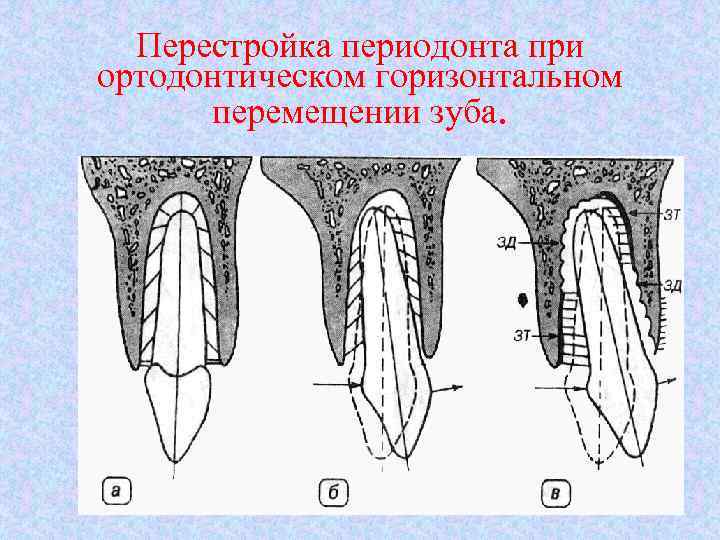 Перестройка периодонта при ортодонтическом горизонтальном перемещении зуба. 