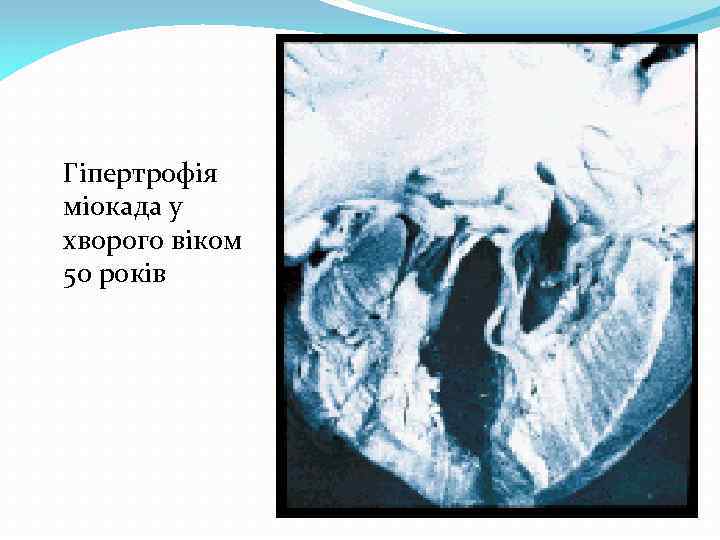 Гіпертрофія міокада у хворого віком 50 років 