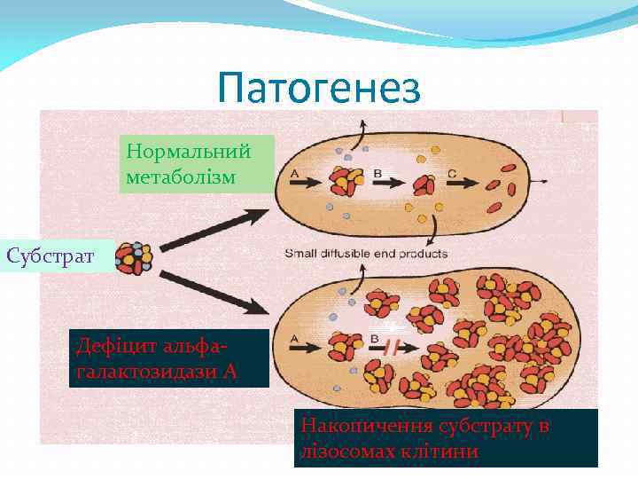 Патогенез Нормальний метаболізм Субстрат Дефіцит альфагалактозидази А Накопичення субстрату в лізосомах клітини 