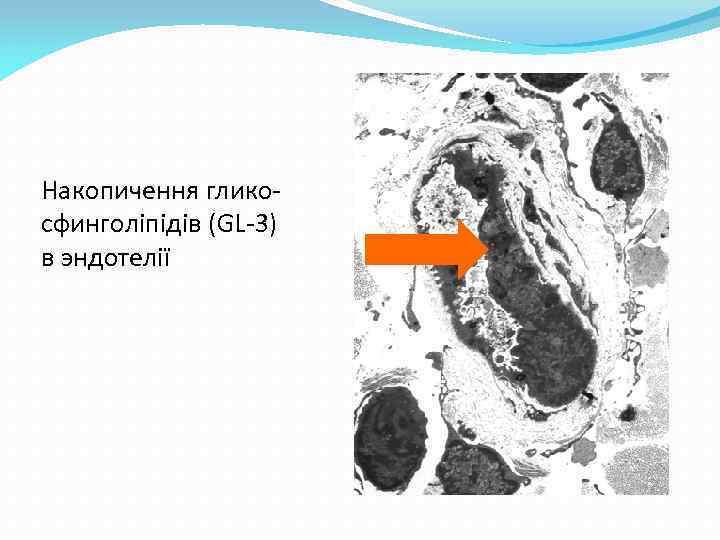 Накопичення гликосфинголіпідів (GL-3) в эндотелії 