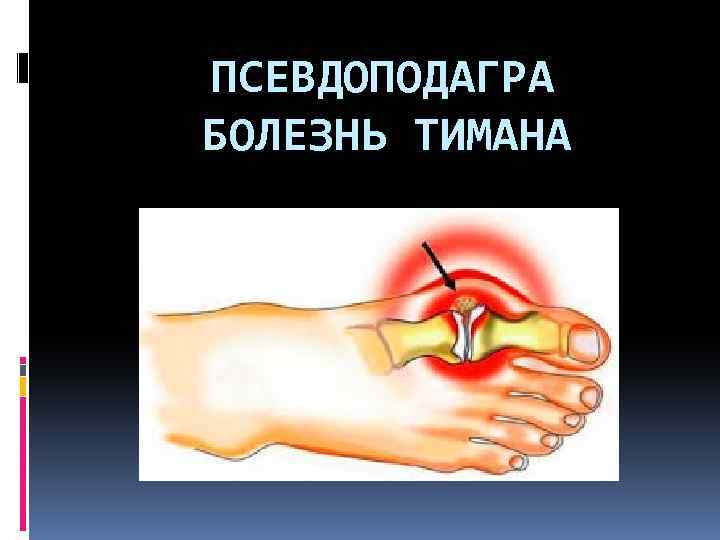 ПСЕВДОПОДАГРА БОЛЕЗНЬ ТИМАНА 