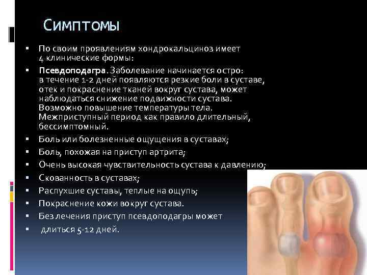 Симптомы По своим проявлениям хондрокальциноз имеет 4 клинические формы: Псевдоподагра. Заболевание начинается остро: в