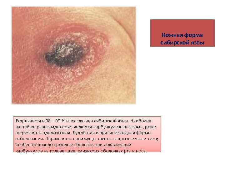 Кожная форма сибирской язвы Встречается в 98— 99 % всех случаев сибирской язвы. Наиболее