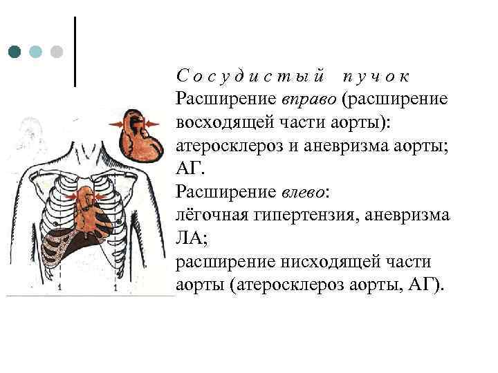 Сосудистый пучок Расширение вправо (расширение восходящей части аорты): атеросклероз и аневризма аорты; АГ. Расширение