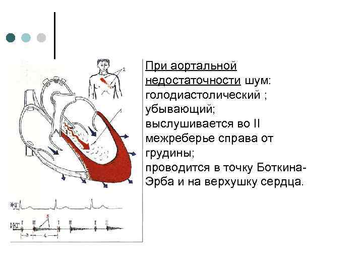 При аортальной недостаточности шум: голодиастолический ; убывающий; выслушивается во II межреберье справа от грудины;