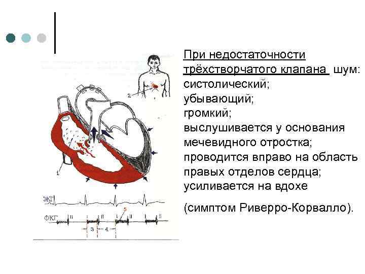 Для аускультативной картины недостаточности митрального клапана характерно