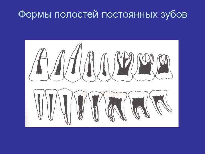 Формы полостей постоянных зубов 