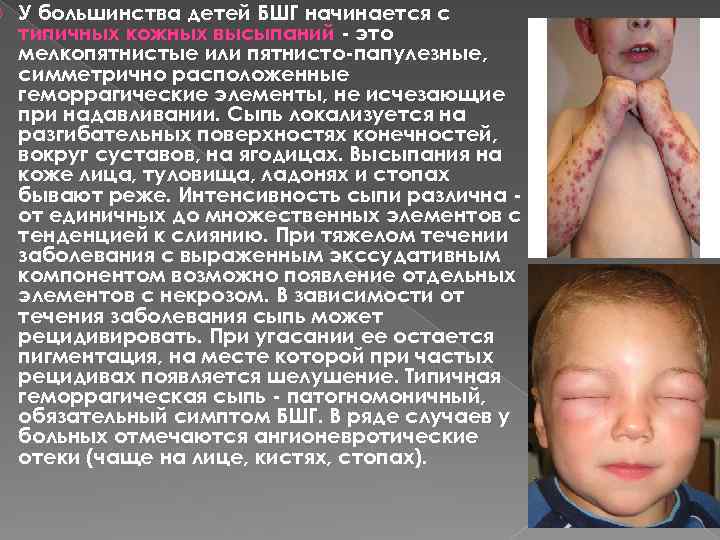  У большинства детей БШГ начинается с типичных кожных высыпаний - это мелкопятнистые или