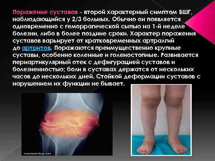 Поражение суставов - второй характерный симптом БШГ, наблюдающийся у 2/3 больных. Обычно он появляется