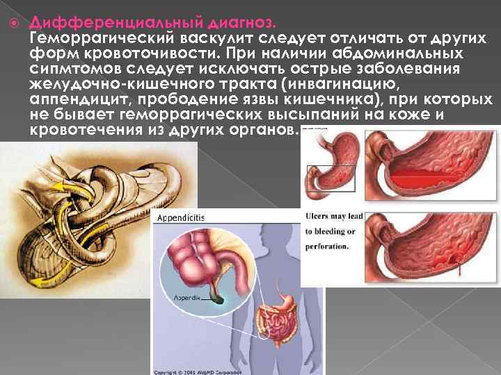 Геморрагический васкулит клиническая картина