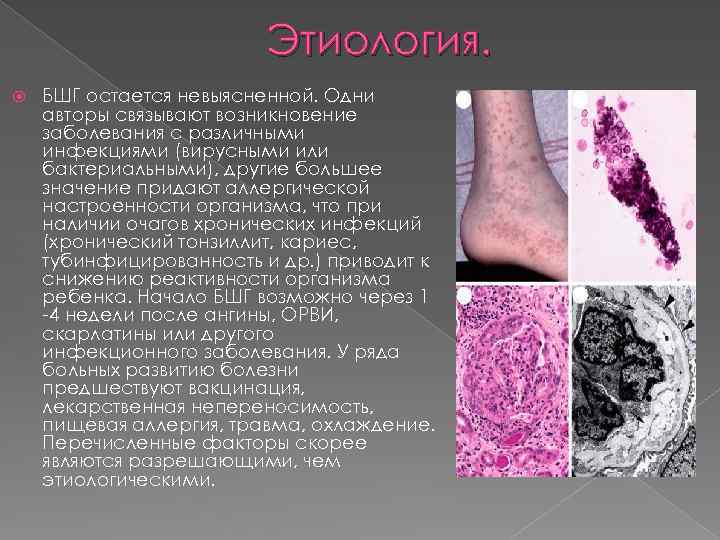 Этиология. БШГ остается невыясненной. Одни авторы связывают возникновение заболевания с различными инфекциями (вирусными или
