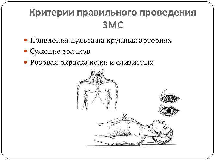 Критерии правильного проведения ЗМС Появления пульса на крупных артериях Сужение зрачков Розовая окраска кожи