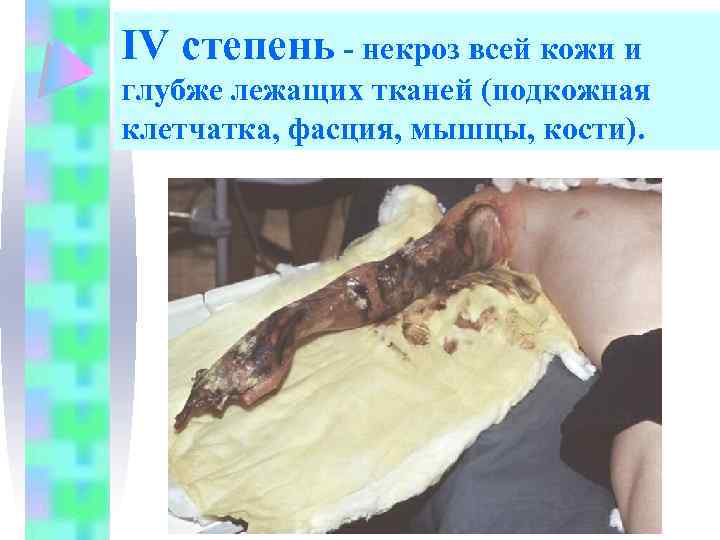 IV степень - некроз всей кожи и глубже лежащих тканей (подкожная клетчатка, фасция, мышцы,