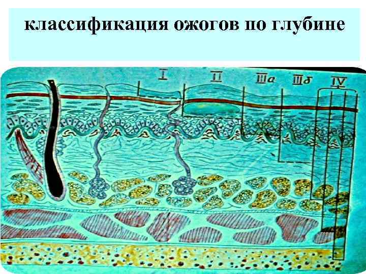классификация ожогов по глубине 