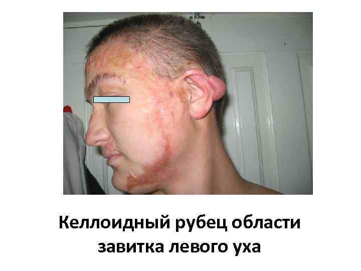 Келлоидный рубец области завитка левого уха 