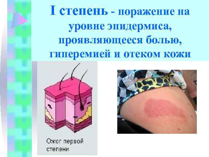 I степень - поражение на уровне эпидермиса, проявляющееся болью, гиперемией и отеком кожи 