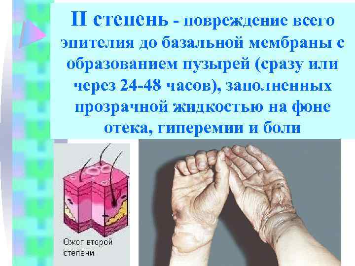 II степень - повреждение всего эпителия до базальной мембраны с образованием пузырей (сразу или