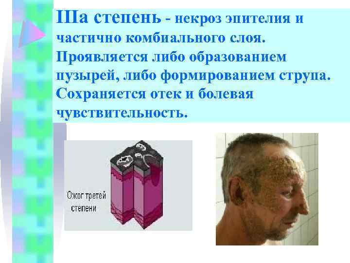 IIIа степень - некроз эпителия и частично комбиального слоя. Проявляется либо образованием пузырей, либо