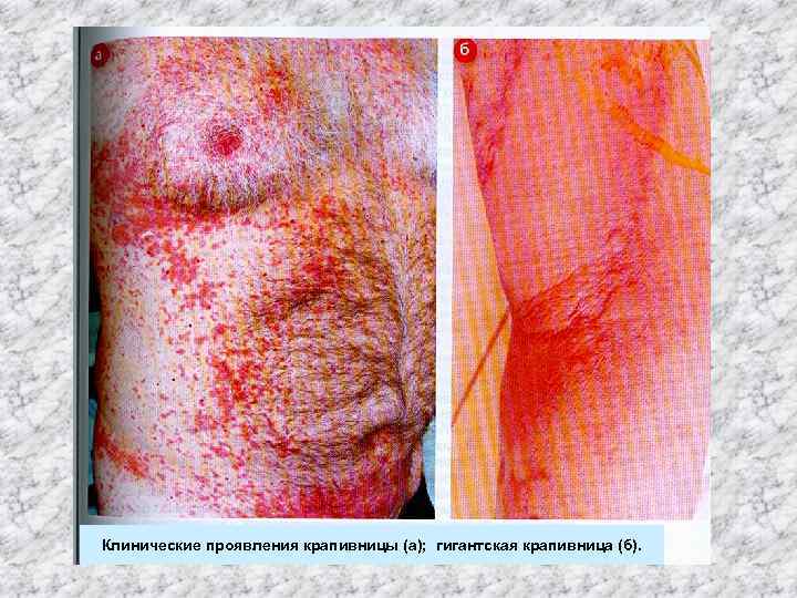 Клинические проявления крапивницы (а); гигантская крапивница (б). 
