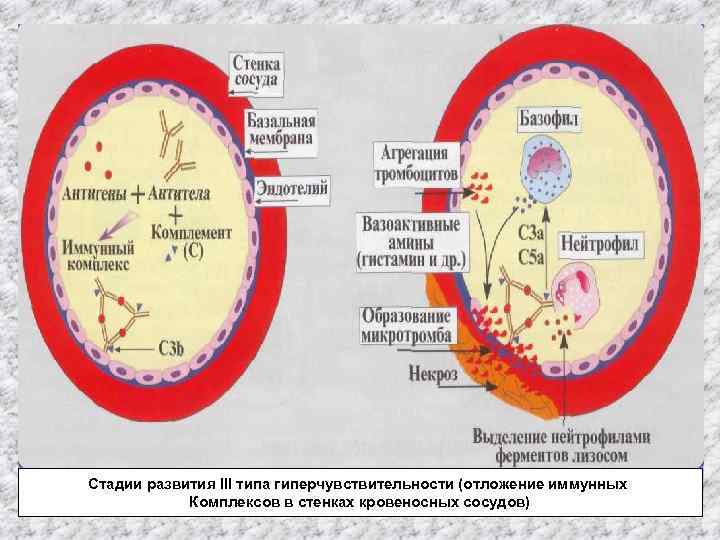 Стадии развития III типа гиперчувствительности (отложение иммунных Комплексов в стенках кровеносных сосудов) 