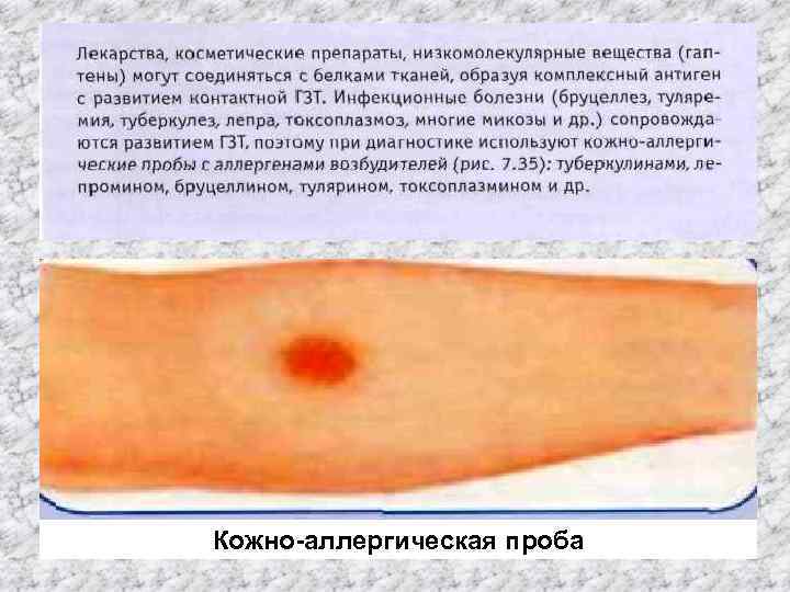 Кожно-аллергическая проба 