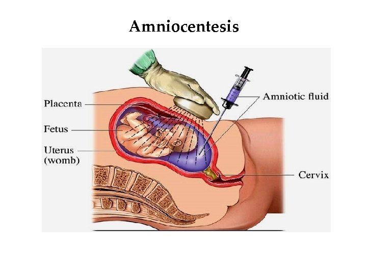 Amniocentesis 