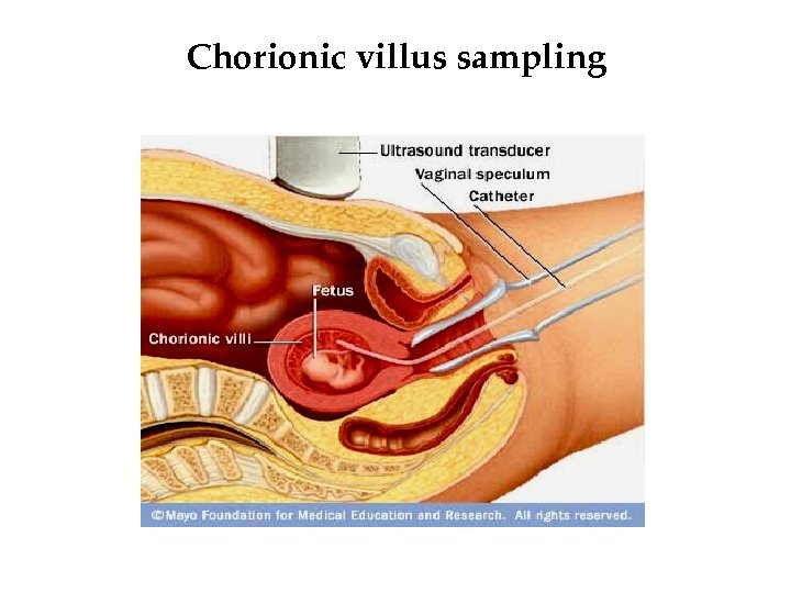 Chorionic villus sampling 