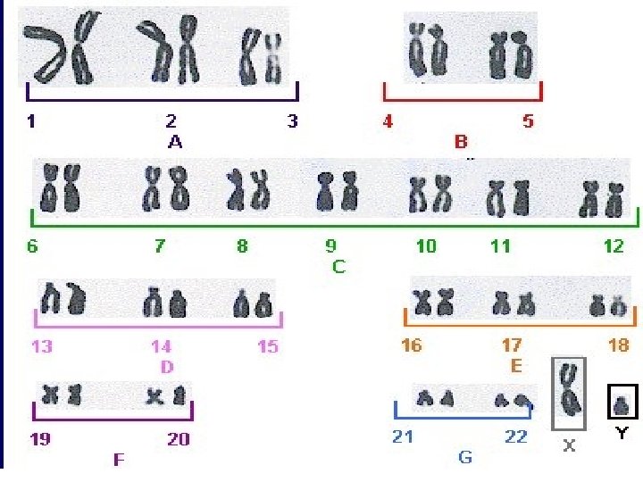 Chromosome Karyotype And Numerical Chromosomal Abnormalities Dr 6509