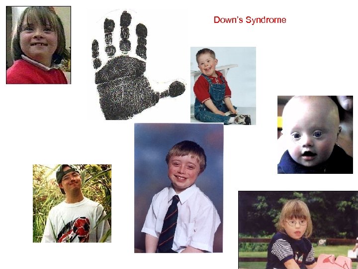 Down’s Syndrome 