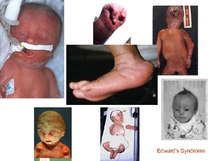 Edward’s Syndrome 