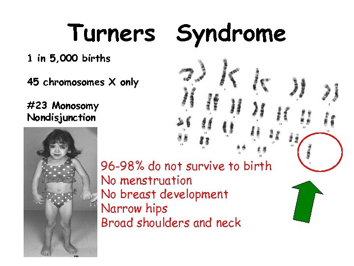 Turners Syndrome 1 in 5, 000 births 45 chromosomes X only #23 Monosomy Nondisjunction