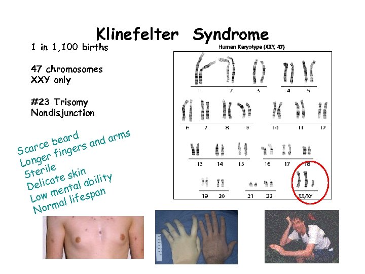 Chromosome Karyotype and Numerical Chromosomal Abnormalities Dr